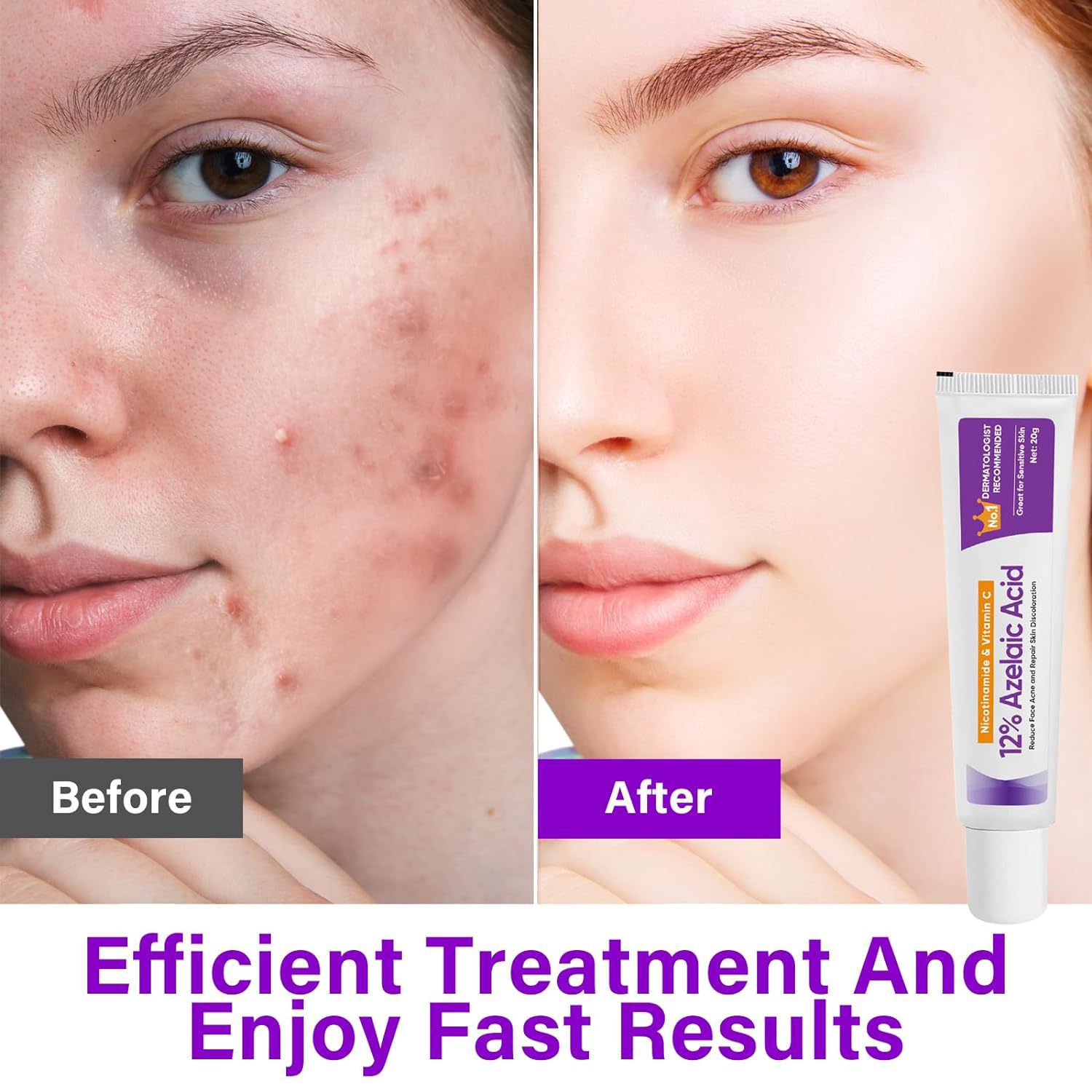 Azelaic Acid Serum, Niacinamide Ointment, Soothing Skin Gel For Fading Acne Scars And Pimples